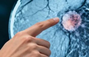 This lymph node is the first to detect if cancer is spreading